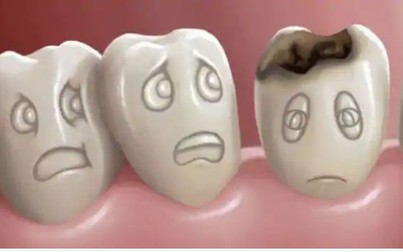 Việc tái tạo men răng trở nên dễ dàng hơn với gel tái khoáng hóa men răng