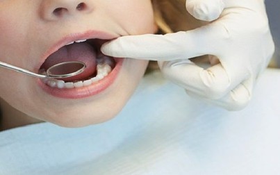 5 lầm tưởng tai hại về quy trình làm trắng răng hiện nay
