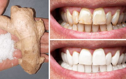 8 cách tự nhiên để làm cho răng trắng hơn tại nhà