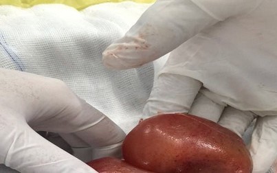 Phẫu thuật thành công cho bé gái 1 ngày tuổi nghi thai trong thai cực hiếm gặp