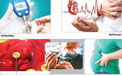 Ðiểm mặt nguy cơ gây đột quỵ