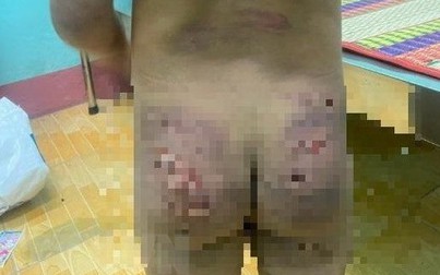 Một bé gái 7 tuổi ở Bình Phước nghi bị bạo hành 