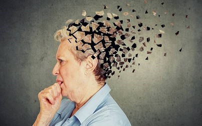 Sắp có thuốc làm chậm sự tiến triển của bệnh Alzheimer