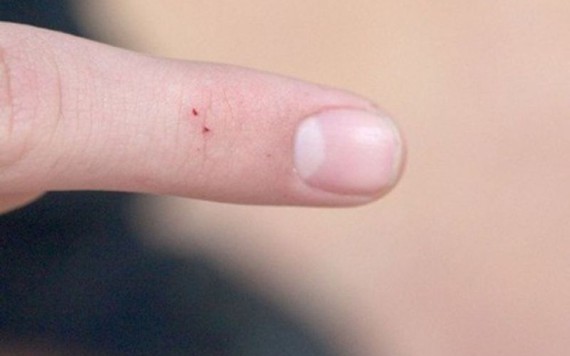 Đừng coi thường 2 chấm đỏ tưởng vô hại này, nó có thể khiến bạn mất mạng chứ chẳng đùa