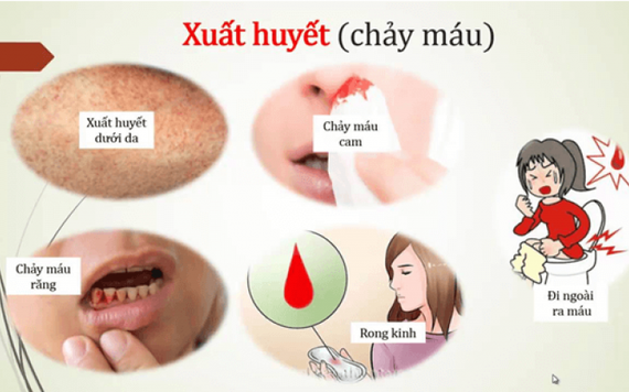 Sốt xuất huyết có lây qua đường tình dục không?