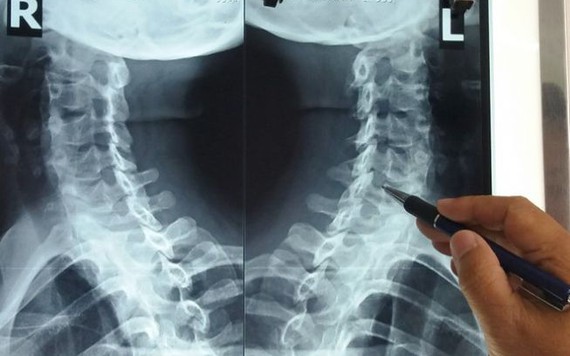 Dân văn phòng đừng chủ quan khi thoái hóa đốt sống cổ