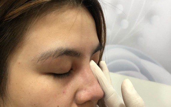 Khi phẫu thuật nâng mũi, cần phải lưu ý những gì?
