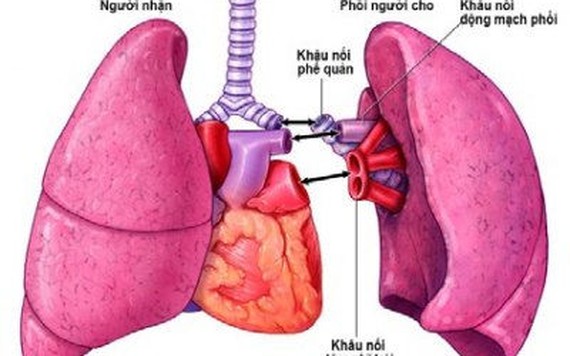COVID-19: Khi nào cần phải ghép phổi?
