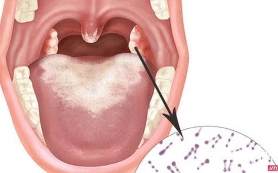 Bệnh bạch hầu: Nguyên nhân, triệu chứng và cách phòng bệnh