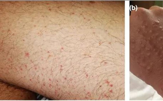5 dấu hiệu điển hình dễ nhận biết trên da của người mắc COVID-19