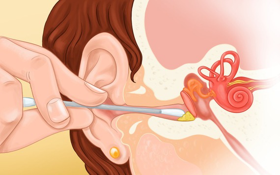 Tại sao bạn nên ngừng vệ sinh tai bằng tăm bông và cách để thay thế