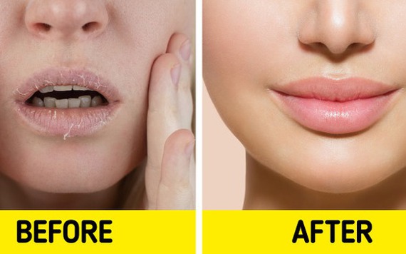 8 biện pháp khắc phục đôi môi khô nứt nẻ của bạn